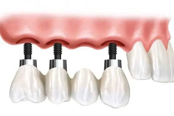 قیمت و مزایای ایمپلنت کره‌ای دنتیس (Dentis) در ایران