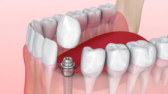 بررسی کیفیت و قیمت ایمپلنت کره‌ای Dentium | مزایا و معایب دنتیوم