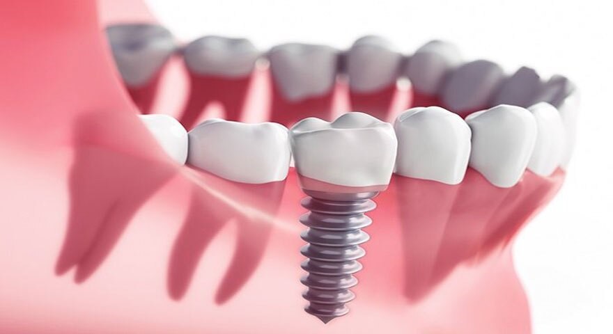 ایمپلنت کره ای یوفیت (UFIT)؛ کیفیت، ماندگاری و قیمت مناسب در کنار زیبایی لبخند