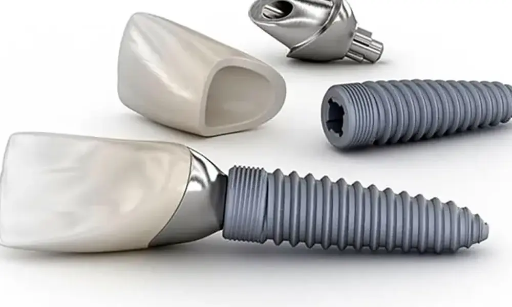 قیمت ایمپلنت برای دندان نیش در تهران