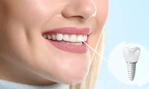 قیمت ایمپلنت در عمان یا دبی بهتر از ایران است؟