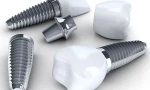 قیمت ایمپلنت برای دندان نیش در تهران