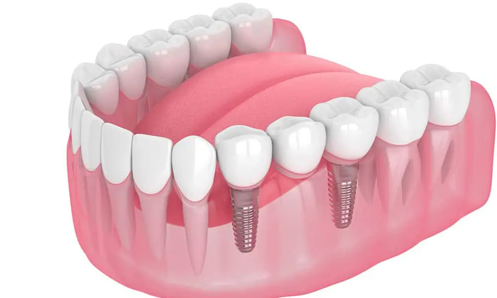 قیمت ایمپلنت در تهران یا ترکیه؟ کدام بهصرفهتر است؟