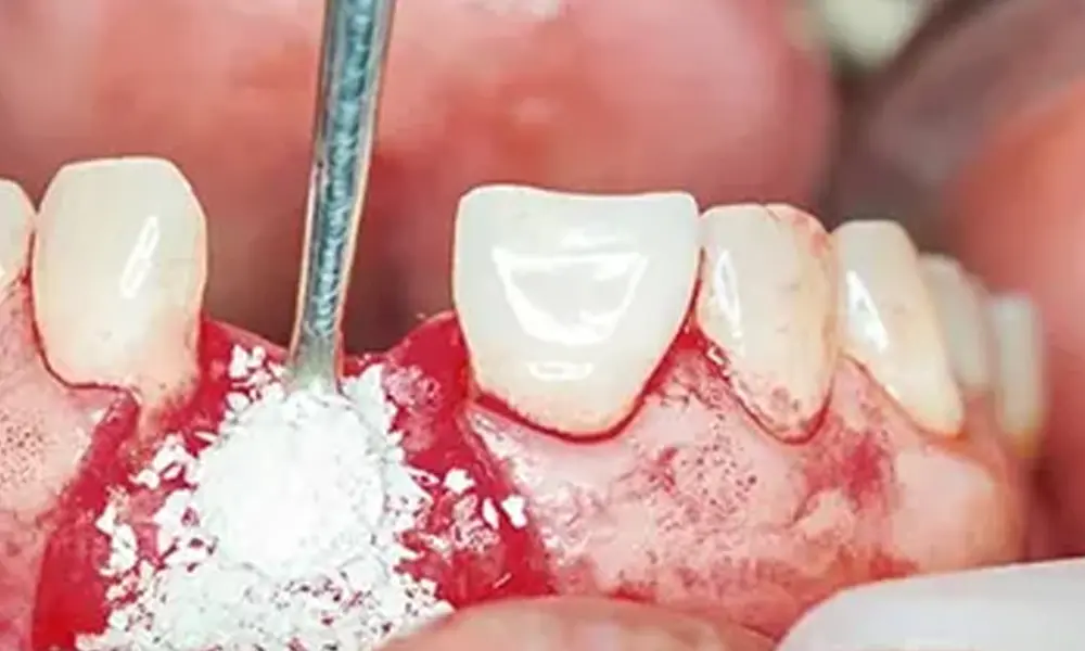 هزینه ایمپلنت مقاوم در برابر تحلیل استخوان