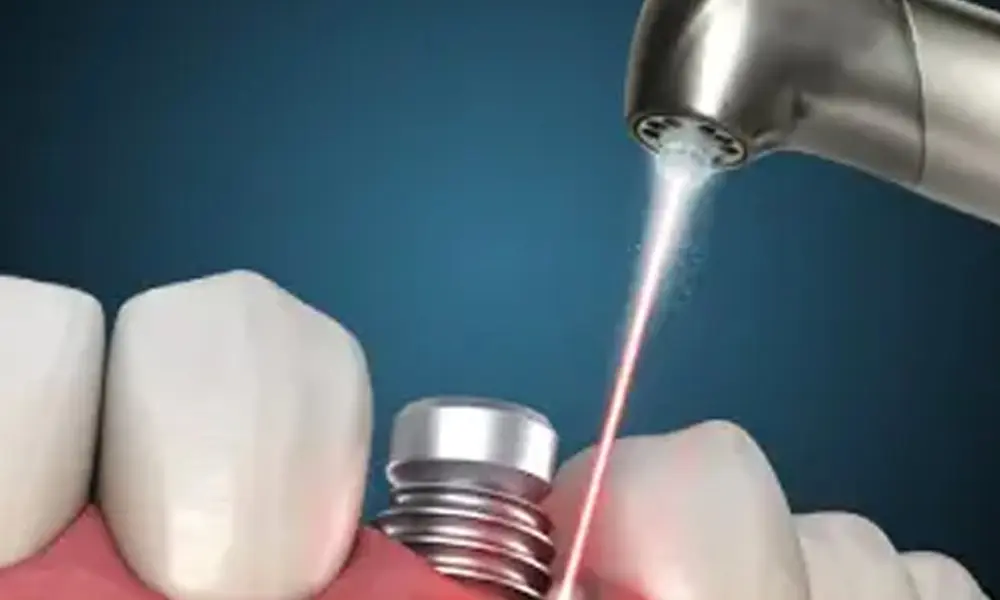 قیمت ایمپلنت با فناوری نوین (لیزر، ایمپلنت دیجیتال)