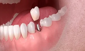 ایمپلنت برای کودکان و نوجوانان