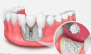 هزینه ایمپلنت مقاوم در برابر تحلیل استخوان