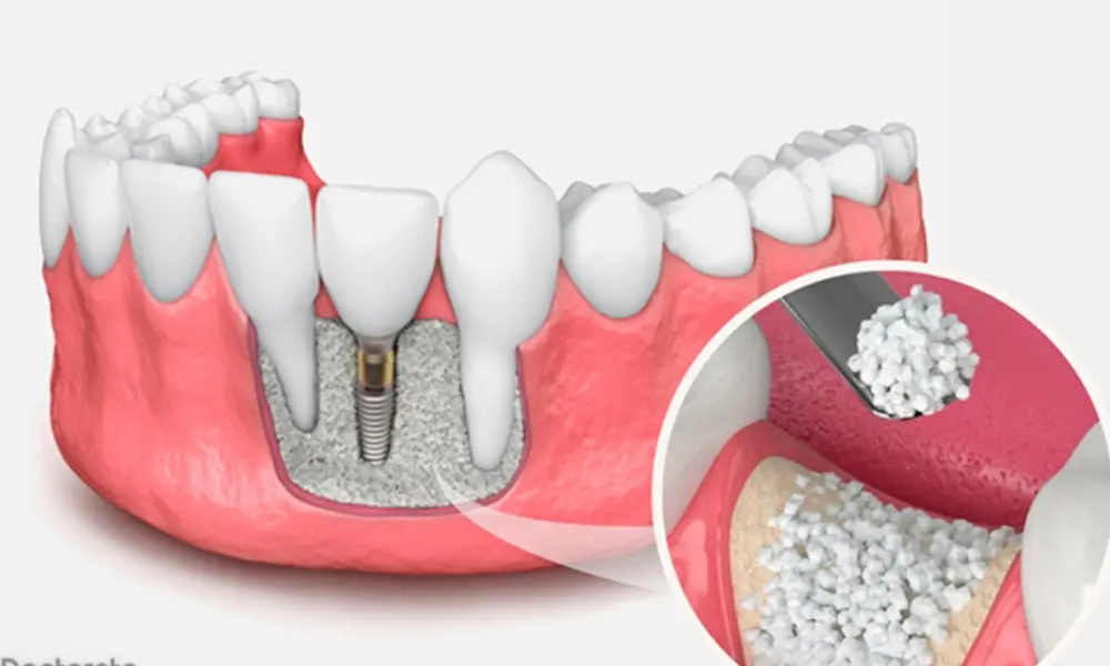 هزینه ایمپلنت مقاوم در برابر تحلیل استخوان