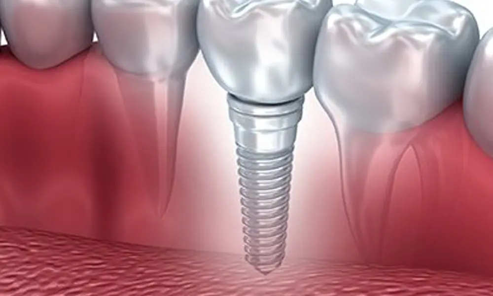 قیمت ایمپلنت با فناوری نوین (لیزر، ایمپلنت دیجیتال)