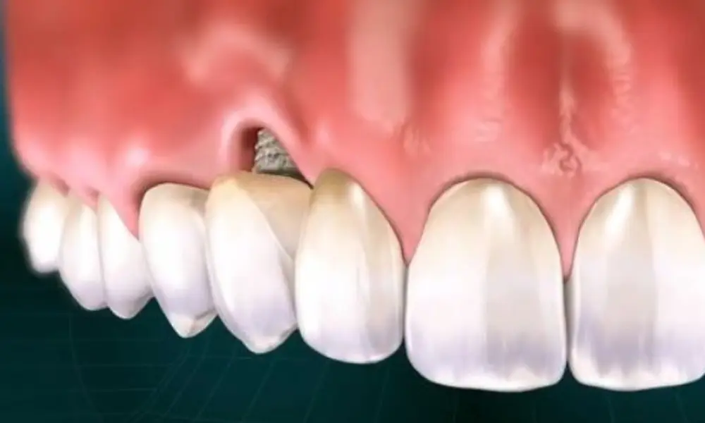 تأثیر نوسان ارز بر قیمت ایمپلنت در تهران