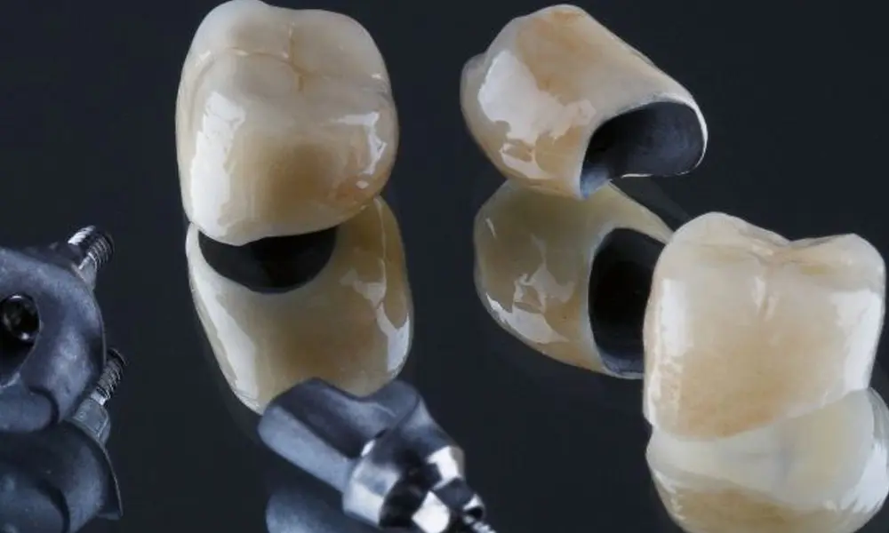 تأثیر نوسان ارز بر قیمت ایمپلنت در تهران