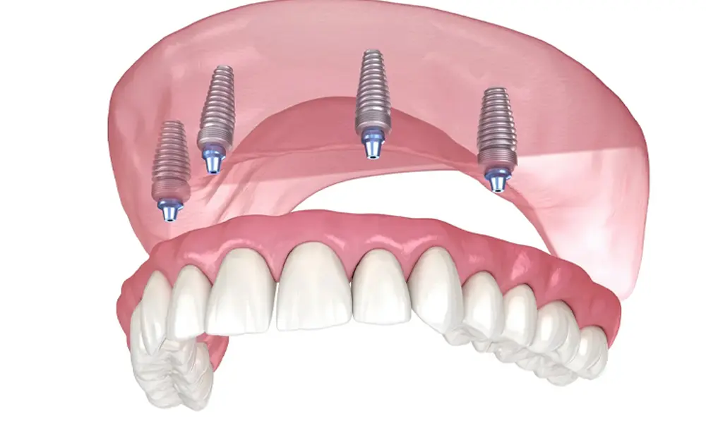 قیمت ایمپلنت در تهران یا ترکیه؟ کدام به‌صرفه‌تر است؟