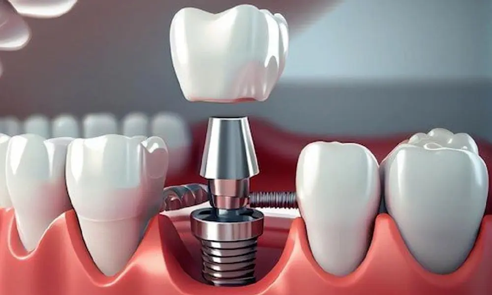 هزینه ایمپلنت برای کودکان و نوجوانان در تهران