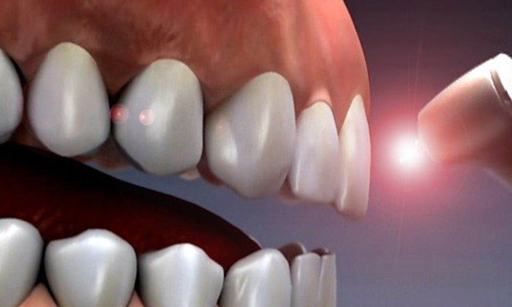 قیمت ایمپلنت با فناوری نوین (لیزر، ایمپلنت دیجیتال)