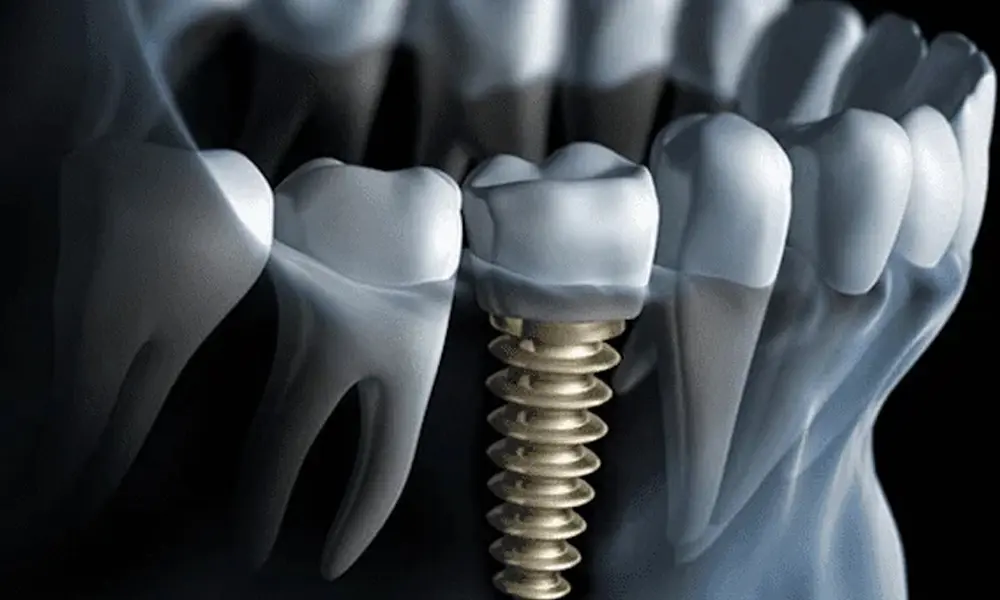 هزینه ایمپلنت برای کودکان و نوجوانان در تهران