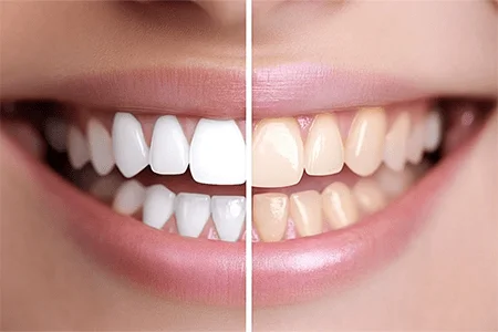 لمینت دندان در اصفهان