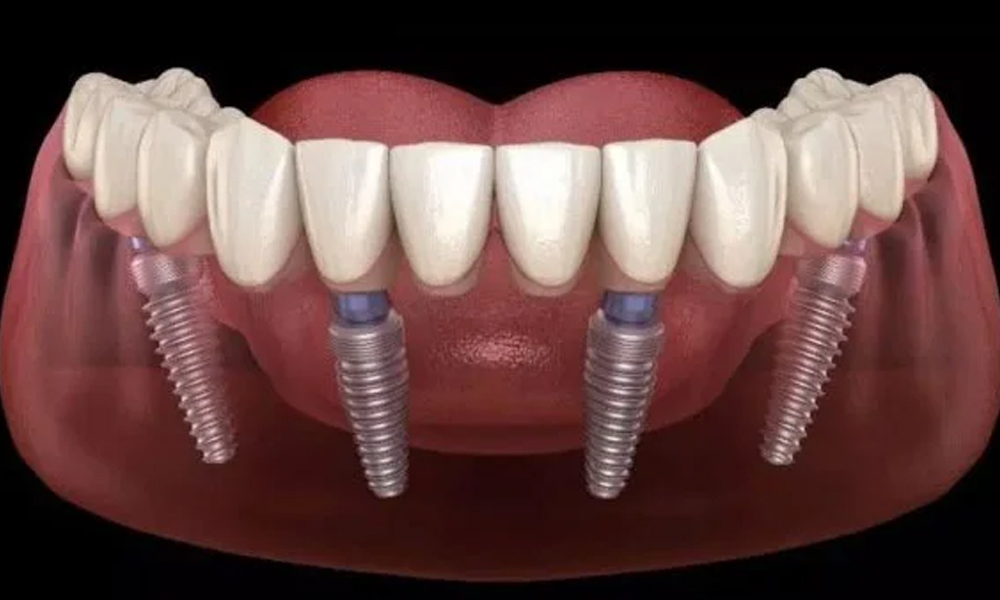 هزینه ایمپلنت کامل فک بالا و پایین در تهران