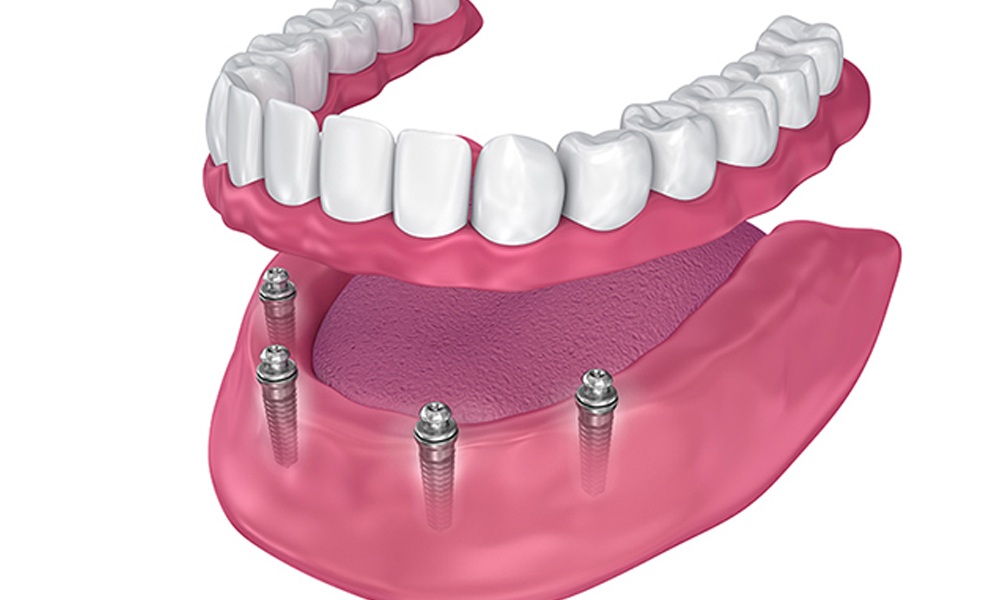 قیمت ایمپلنت در تهران یا ترکیه؟ کدام به‌صرفه‌تر است؟