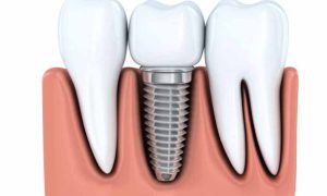 هزینه ایمپلنت برای دندان آسیاب بزرگ در تهران
