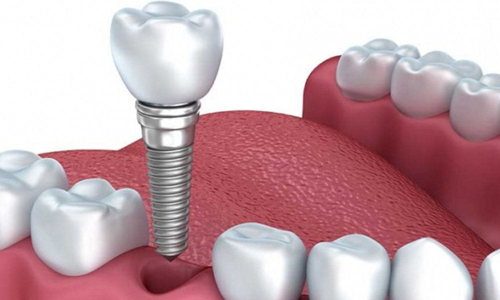 هزینه ایمپلنت برای دندان آسیاب بزرگ در تهران