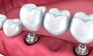 ایمپلنت اقساطی در تهران؛ شرایط و هزینه‌ها