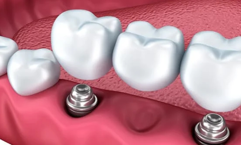 ایمپلنت اقساطی در تهران؛ شرایط و هزینهها