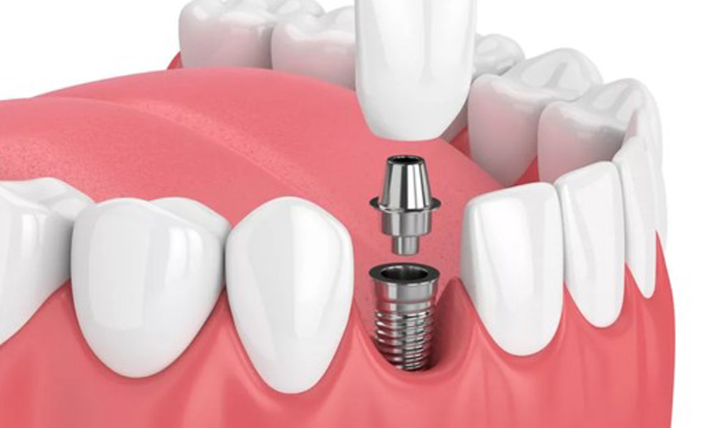 ایمپلنت اقساطی در تهران؛ شرایط و هزینه‌ها