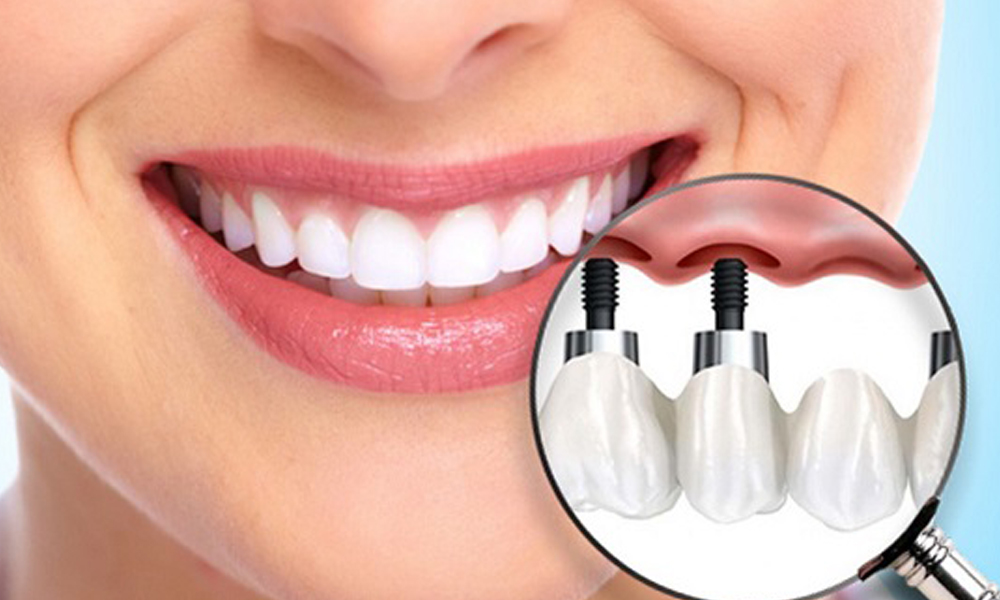 ایمپلنت اقساطی در تهران؛ شرایط و هزینه‌ها