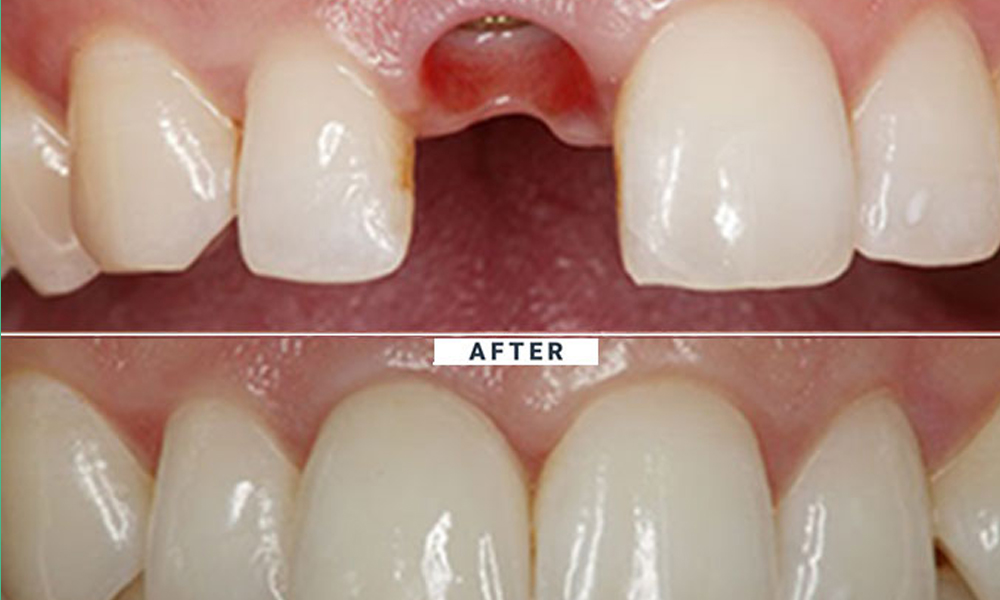 قیمت ایمپلنت برندهای معروف (اشترومن، نئودنت، آلمانی، کره‌ای) در تهران