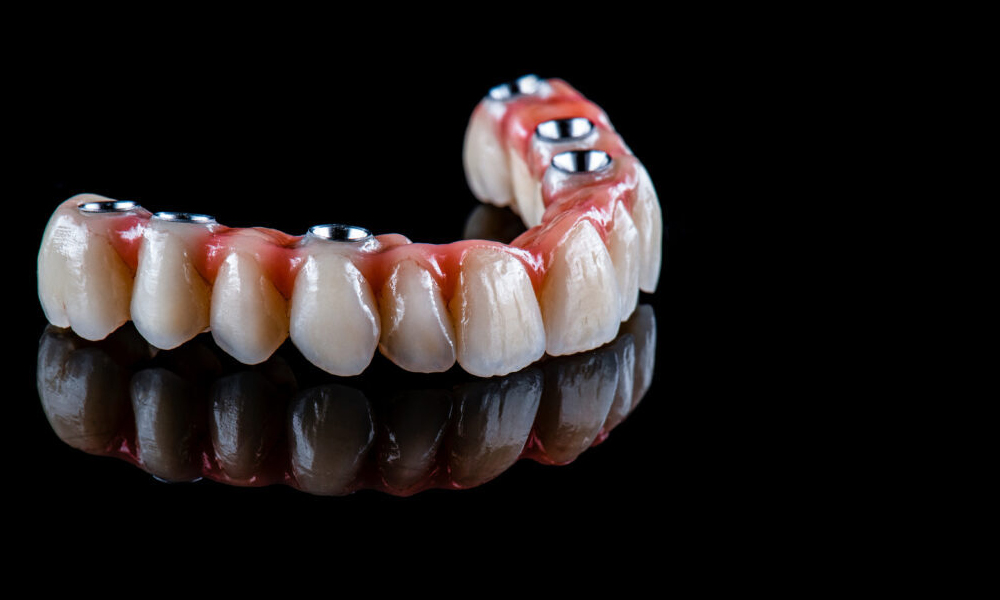 هزینه ایمپلنت کامل فک بالا و پایین در تهران