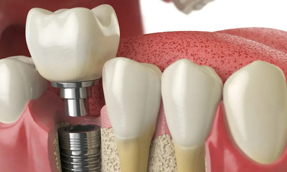 قیمت ایمپلنت در عمان یا دبی بهتر از ایران است؟