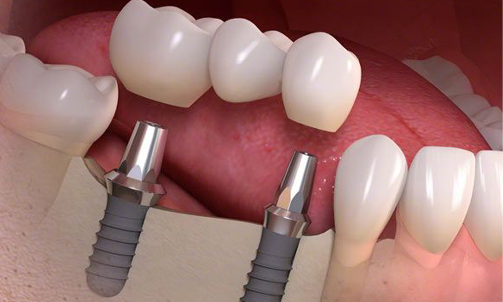 هزینه ایمپلنتگذاری چند واحدی در تهران