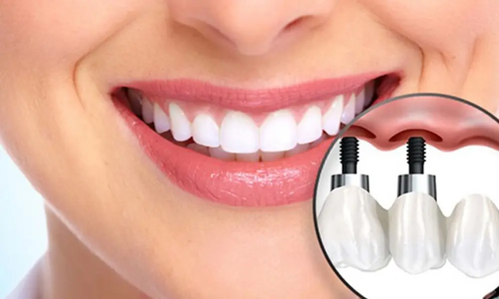 قیمت ایمپلنت برای شهروندان تهرانی و غیرتهرانی