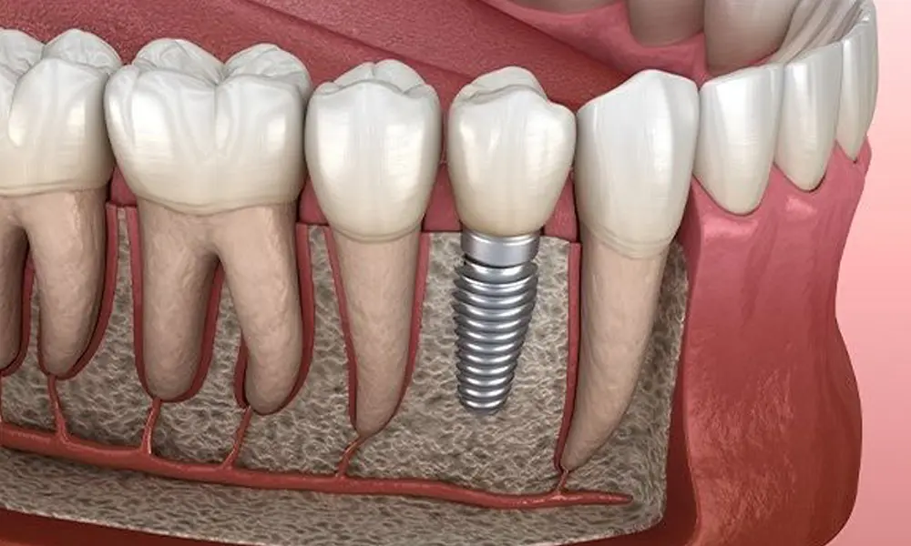 قیمت ایمپلنت برای بازسازی فک در تهران