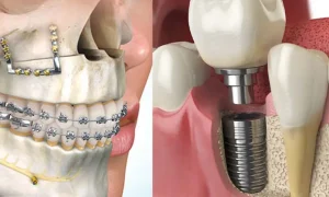 قیمت ایمپلنت برای شهروندان تهرانی و غیرتهرانی