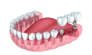 حجم واحد ایمپلنت