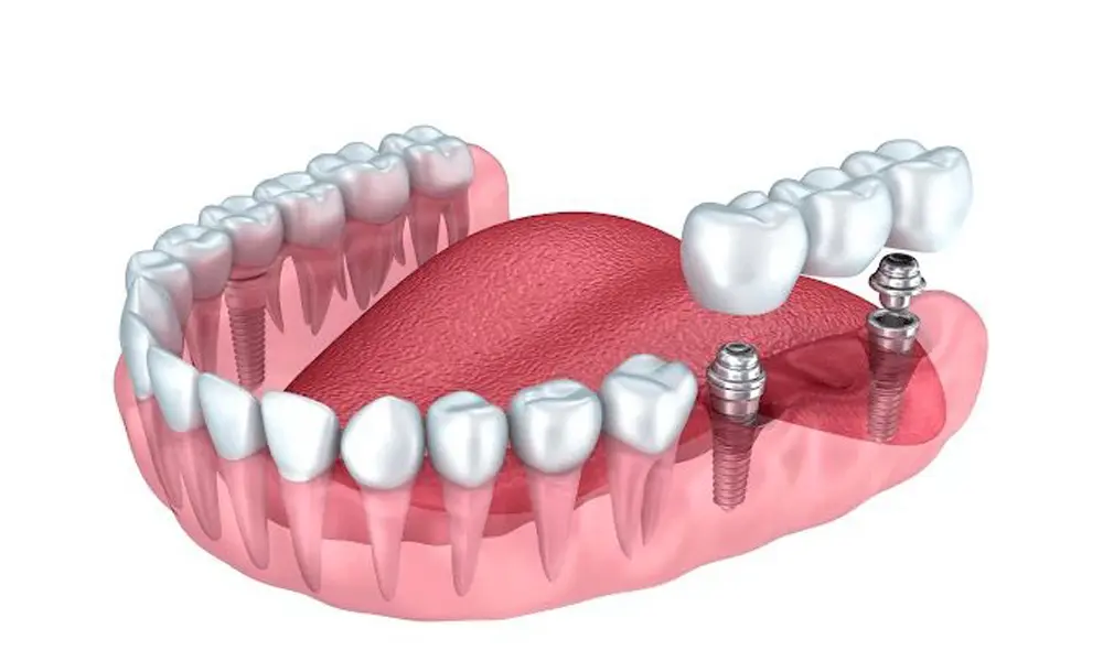 حجم واحد ایمپلنت