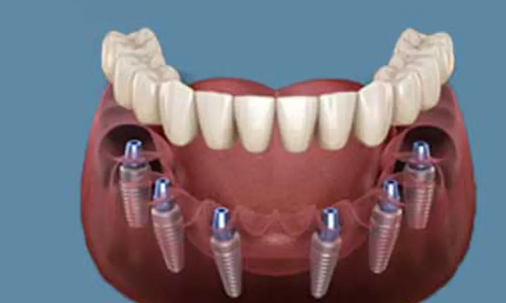 قیمت ایمپلنت برای شهروندان تهرانی و غیرتهرانی