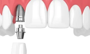 هزینه ایجاد اسکن ۳ بعدی برای ایمپلنت