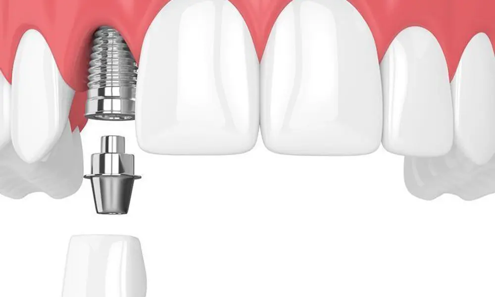 هزینه ایجاد اسکن ۳ بعدی برای ایمپلنت