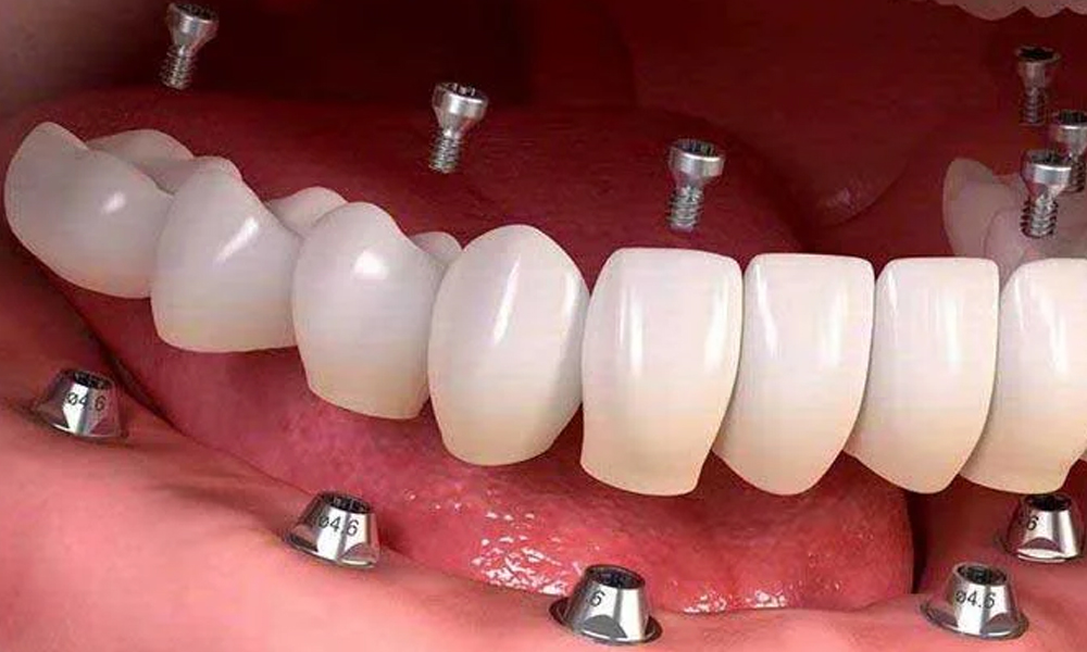 قیمت ایمپلنت دندان + هزینه پودر استخوان و قیمت نهایی در سال ۱۴۰۴