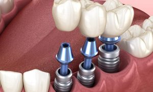 تأثیر سابقه و توانایی دندانپزشک متخصص ایمپلنت بر قیمتها