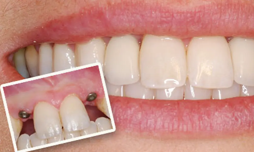 تأثیر سابقه و توانایی دندانپزشک متخصص ایمپلنت بر قیمت‌ها