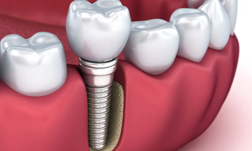قیمت ایمپلنت برای بازسازی فک در تهران