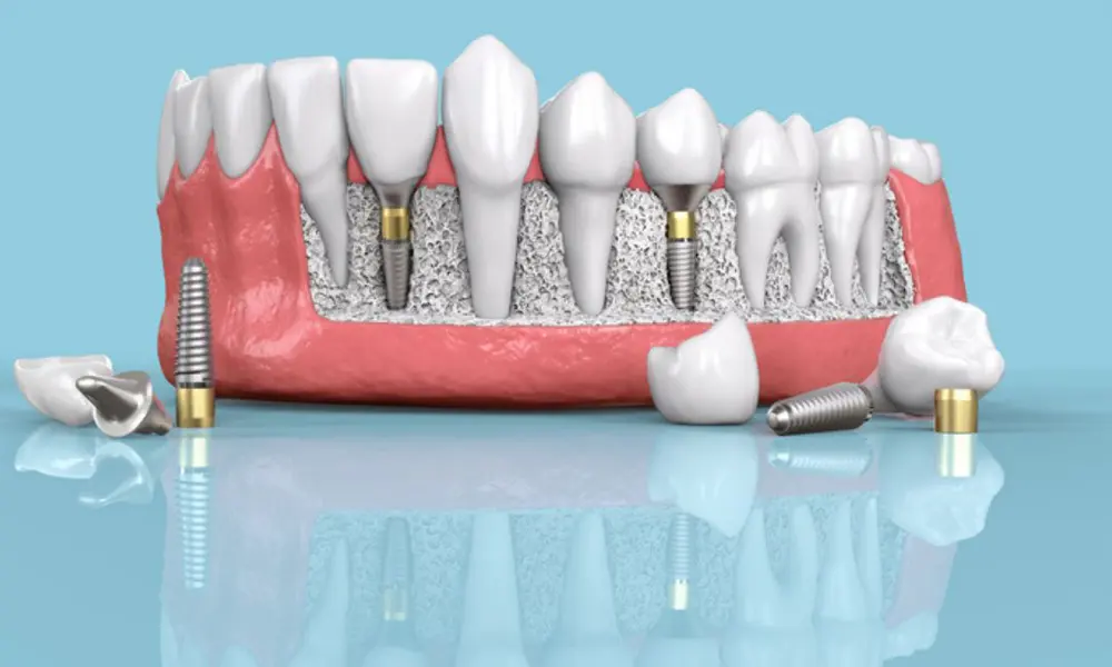 هزینه ایجاد اسکن ۳ بعدی برای ایمپلنت