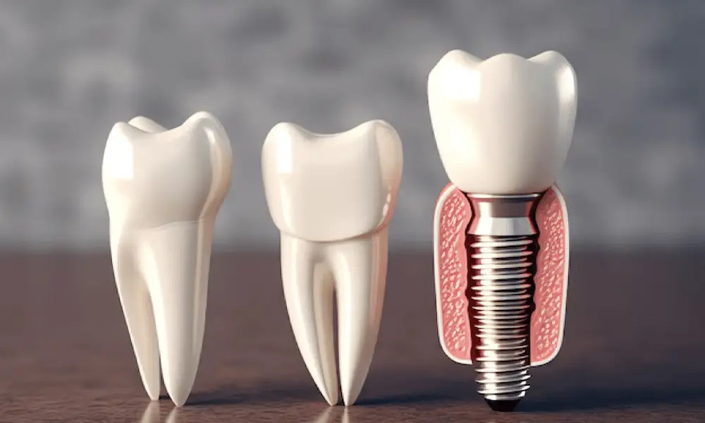 قیمت ایمپلنت دندان + هزینه پودر استخوان و قیمت نهایی در سال ۱۴۰۴
