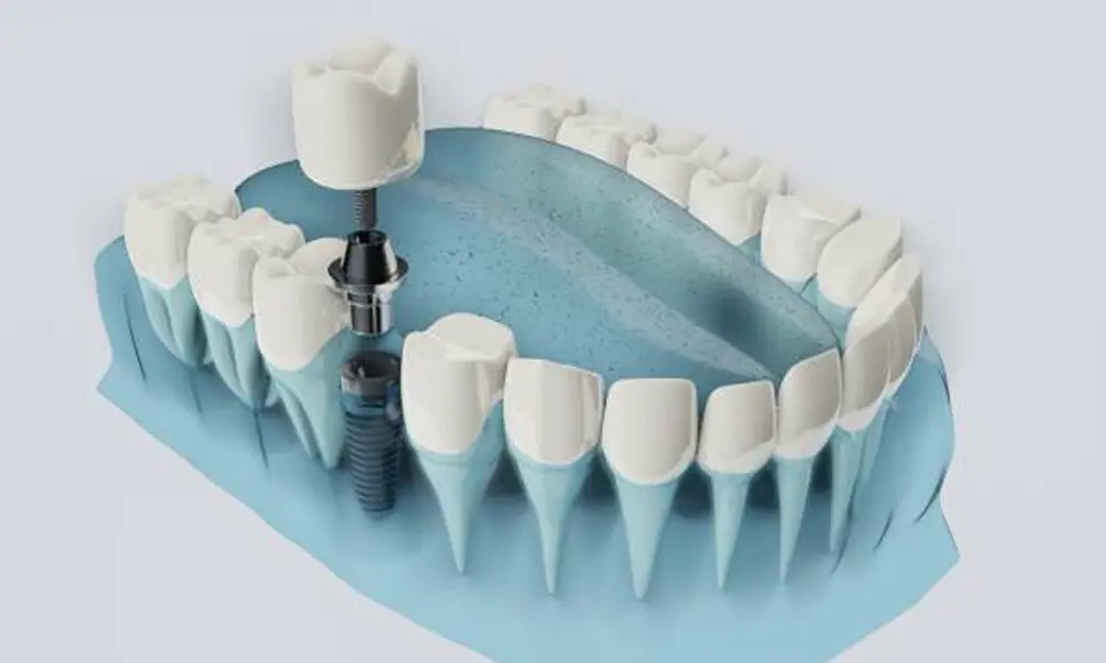 ایمپلنت دندان یکی از موثرترین روش‌ها برای جایگزینی دندان‌های از دست رفته است و امروزه جایگاه ویژه‌ای در دندان‌پزشکی پیدا کرده است. با این حال، در سال‌های اخیر شاهد کاهش قیمت برخی خدمات ایمپلنت هستیم که ممکن است جذاب به نظر برسد. اما آیا همیشه کاهش قیمت به نفع شماست؟ بررسی دقیق این موضوع نشان می‌دهد که ریسک‌های مهمی برای سلامت دهان و سرمایه شما می‌تواند وجود داشته باشد. در این مقاله، با زبانی ساده و کاربردی، ریسک‌ها، مزایا و نکات کلیدی کاهش قیمت ایمپلنت را بررسی می‌کنیم تا شما تصمیمی آگاهانه بگیرید و از سلامت و دوام ایمپلنت خود محافظت کنید. چرا قیمت ایمپلنت دندان بالا است؟ یکی از سوالات رایج بیماران این است که چرا قیمت ایمپلنت دندان نسبت به سایر روش‌های درمان دندانپزشکی بسیار بالاتر است. برای پاسخ به این سوال، لازم است همه عوامل تاثیرگذار بررسی شوند تا دلیل واقعی بالا بودن هزینه‌ها روشن شود. مواد اولیه با کیفیت بالا یکی از مهم‌ترین دلایل افزایش قیمت ایمپلنت دندان، استفاده از مواد اولیه با کیفیت است. ایمپلنت‌ها عمدتاً از تیتانیوم یا سرامیک ساخته می‌شوند که هر دو ماده دارای استحکام بالا، سازگاری زیستی و طول عمر طولانی هستند. استفاده از این مواد گران‌قیمت باعث می‌شود ایمپلنت بتواند سال‌ها بدون هیچ مشکلی در دهان باقی بماند و با استخوان فک به خوبی جوش بخورد. بنابراین، هزینه مواد اولیه به طور مستقیم روی قیمت نهایی ایمپلنت تاثیر می‌گذارد. تکنولوژی و تجهیزات پیشرفته ایمپلنت دندان نیازمند تجهیزات و تکنولوژی‌های پیشرفته است. از تصویربرداری سه‌بعدی تا ابزارهای دقیق جراحی، هر مرحله نیازمند دستگاه‌های تخصصی و گران‌قیمت است. تکنولوژی‌های مدرن، امکان جراحی دقیق‌تر، کاهش عوارض و بهبود نتیجه درمان را فراهم می‌کنند، اما هزینه تجهیزات و نگهداری آن‌ها نیز به قیمت نهایی اضافه می‌شود. مراکزی که از تکنولوژی‌های استاندارد استفاده می‌کنند، کیفیت درمان بالاتری ارائه می‌دهند و این یکی از دلایل اصلی قیمت بالا است. تخصص و مهارت پزشک عامل دیگری که قیمت ایمپلنت را بالا نگه می‌دارد، تخصص و تجربه دندان‌پزشک است. کاشت ایمپلنت یک فرآیند دقیق و حساس است و نیازمند مهارت‌های جراحی و دانش گسترده در زمینه آناتومی دهان و فک است. دندان‌پزشکان متخصص برای هر مرحله از درمان، برنامه‌ریزی دقیق انجام می‌دهند تا احتمال شکست کاهش یابد و دوام ایمپلنت افزایش پیدا کند. تجربه و مهارت پزشک، نه تنها کیفیت درمان، بلکه هزینه نهایی را نیز تحت تاثیر قرار می‌دهد. مراحل پیچیده درمان ایمپلنت دندان شامل چندین مرحله است: معاینه اولیه، تصویربرداری، جراحی کاشت ایمپلنت، دوره بهبود و نصب تاج نهایی. هر یک از این مراحل نیازمند زمان، دقت و مراقبت‌های تخصصی است. همچنین برخی بیماران نیازمند جراحی‌های اضافی مانند پیوند استخوان یا لیفت سینوس هستند که هزینه‌ها را بیشتر می‌کنند. بنابراین پیچیدگی مراحل درمان، یکی دیگر از دلایل قیمت بالای ایمپلنت است.