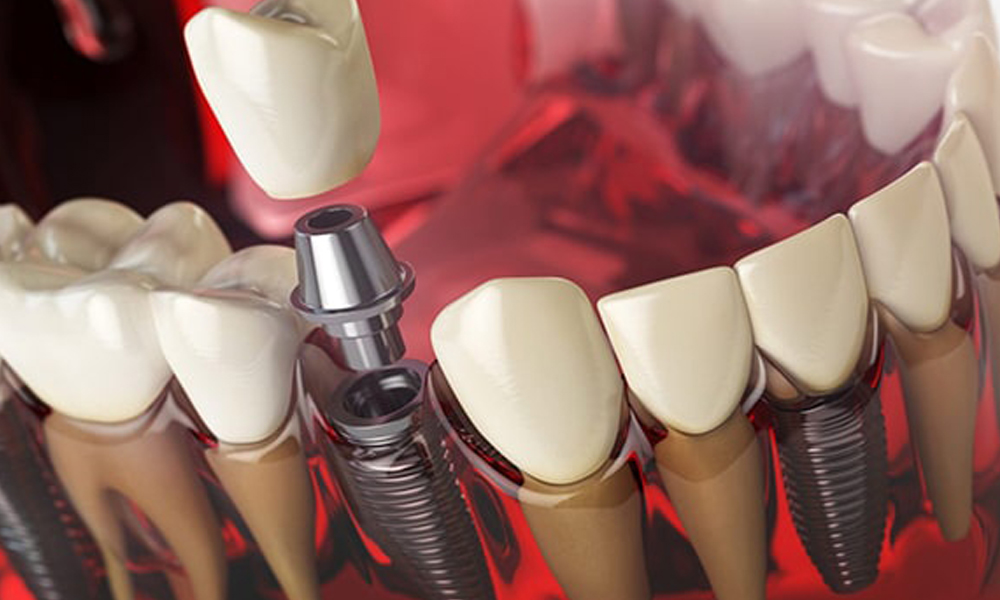 مقایسه قیمت ایمپلنت برند ناشناخته با برندهای بزرگ