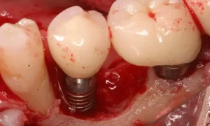 مقایسه قیمت ایمپلنت برند ناشناخته با برندهای بزرگ