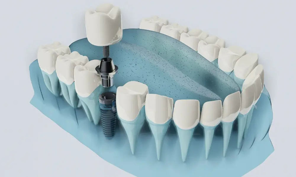 چرا هزینه پودر استخوان روی قیمت ایمپلنت تأثیر دارد؟ بسیاری از مراجعان تصور می‌کنند قیمت ایمپلنت یک عدد ثابت است، اما واقعیت این است که این درمان شامل مجموعه‌ای از مراحل و مواد تخصصی است. یکی از مهم‌ترین این موارد، پودر استخوان است. پودر استخوان زمانی استفاده می‌شود که تراکم استخوان فک پایین باشد و ایمپلنت به‌تنهایی قادر به اتصال ایمن به استخوان نباشد. وقتی حجم استخوان کافی نباشد، دندان‌پزشک برای ایجاد بستر مناسب، از پودر استخوان استفاده می‌کند تا استخوان‌سازی انجام شود و ایمپلنت به‌صورت کامل با استخوان فک جوش بخورد. این موضوع در ظاهر ساده است اما تأثیر مستقیمی روی کیفیت درمان، طول عمر ایمپلنت و البته هزینه نهایی دارد. قیمت ایمپلنت دندان در سال ۱۴۰۴ چقدر است؟ قیمت ایمپلنت به عوامل زیادی بستگی دارد: برند، کشور سازنده، نوع روکش، تخصص جراح، تکنیک جراحی، کیفیت پودر استخوان و حتی موقعیت دندان. اما در یک نگاه کلی، قیمت ایمپلنت در سال ۱۴۰۴ به‌صورت زیر است: جدول قیمت ایمپلنت دندان + هزینه پودر استخوان نوع ایمپلنت محدوده قیمت (۱۴۰۴) توضیحات ایمپلنت کره‌ای 9 تا 14 میلیون قیمت مناسب + کیفیت قابل قبول ایمپلنت آلمانی 14 تا 22 میلیون دوام بالا + برند معتبر ایمپلنت سوئیسی 20 تا 32 میلیون طول عمر بالا + درصد موفقیت بیش از ۹۸٪ هزینه پودر استخوان ۱/۵ تا ۵ میلیون بسته به مقدار و برند متفاوت است سینوس لیفت 5 تا 12 میلیون فقط در صورت نیاز انجام می‌شود هزینه پودر استخوان دقیقاً چطور تعیین می‌شود؟ هزینه پودر استخوان یک عدد ثابت نیست؛ بلکه بر اساس چند معیار متفاوت محاسبه می‌شود: 1. نوع پودر استخوان پودر استخوان در چند نوع موجود است: پودر استخوان طبیعی (اتوژن) برداشت از بدن خود فرد – هزینه کمتر اما فرآیند استخراج سخت‌تر. پودر استخوان انسانی (آلوژن) کیفیت بالا، قیمت متوسط. پودر استخوان حیوانی (زنوگرافت) پرکاربردترین نوع – قیمت مناسب + سازگاری بالا. پودر استخوان مصنوعی (سنتتیک) بالاترین قیمت – مناسب برای شرایط خاص. 2. مقدار پودر استخوان مورد نیاز هر فک با توجه به تحلیل استخوان، مقدار متفاوتی پودر احتیاج دارد. هرچه تحلیل بیشتر باشد، هزینه پودر استخوان نیز افزایش پیدا می‌کند. 3. برند و کشور سازنده برندهای اروپایی معمولاً گران‌تر از نمونه‌های کره‌ای یا ایرانی هستند، اما کیفیت بالاتری نیز ارائه می‌دهند.